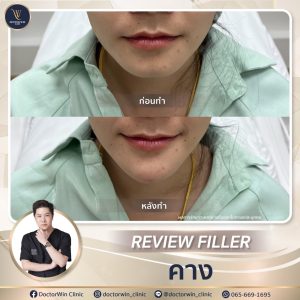 รีวิวฉีดฟิลเลอร์คาง