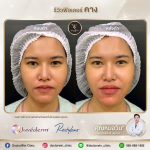 รีวิวฉีดฟิลเลอร์คาง