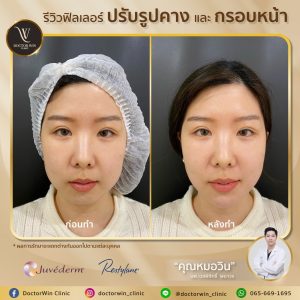 รีวิวฉีดฟิลเลอร์คาง