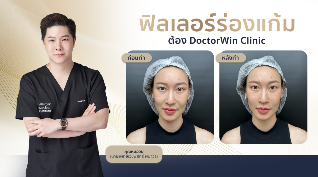 รีวิวฉีดฟิลเลอร์ร่องแก้ม