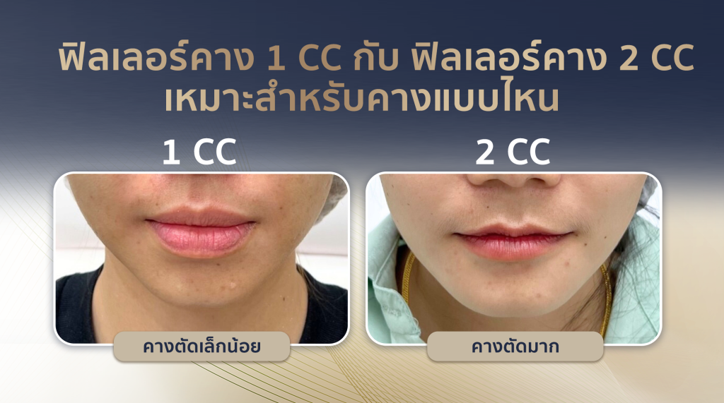 ฉีดคาง 1 cc